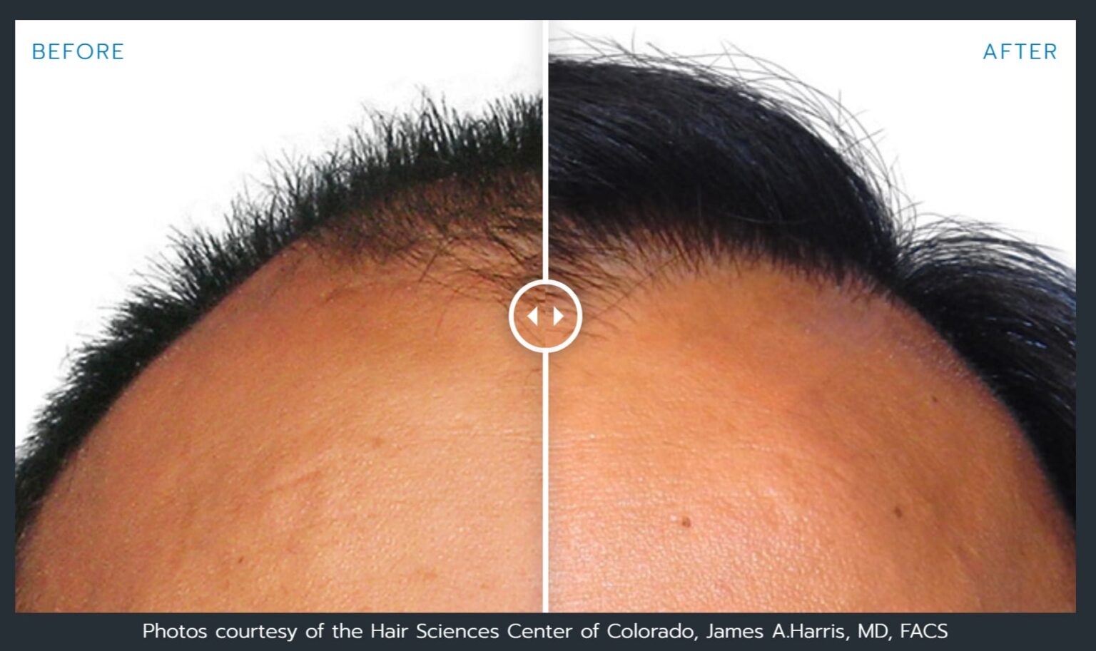 Artas Robotic Hair Restoration Before And After Photos Atlanta