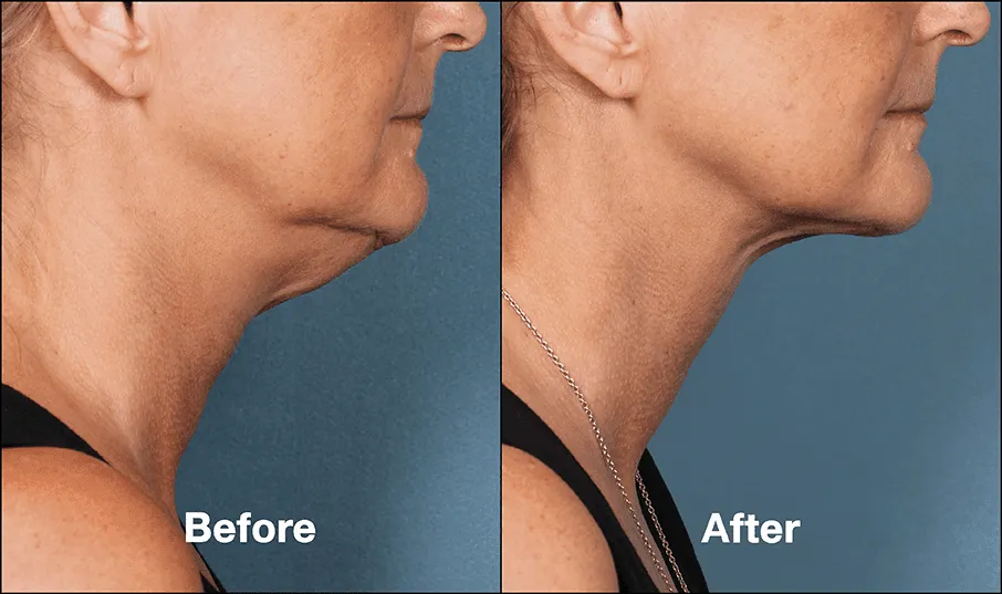 Neck Lift Before and After
