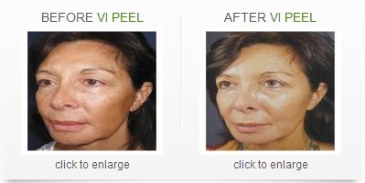 New VI Peel Products Available