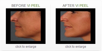 New VI Peel Products Available