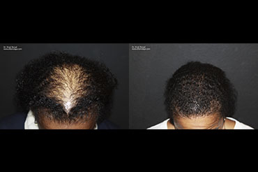 African American Hair Restoration Transplants With SmartGraft Before And After Pictures