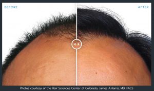 Artas Robotic Hair Restoration / Transplant Before And After Photos