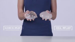 IDEAL IMPLANT Before &#038; After Photos 