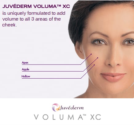 Juvederm Volbella is Used to Define Lips And Remove Fine Wrinkles 
