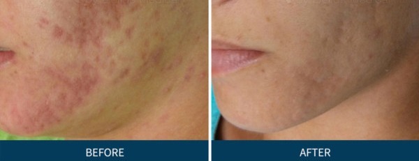 Microneedling With PRP 