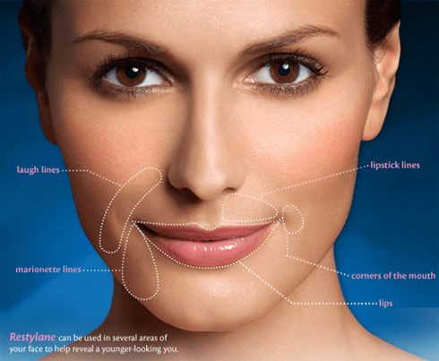 What Is Restylane Dermal Filler Used For?
