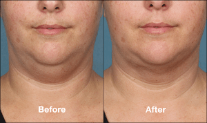 How Much Does Kybella Injectable Cost?
