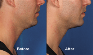 KYBELLA Injectable Double Chin Reduction Before And After Photos