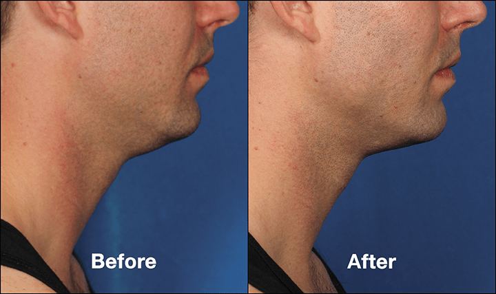 KYBELLA Injectable Double Chin Reduction Before After Photos | Atlanta ...