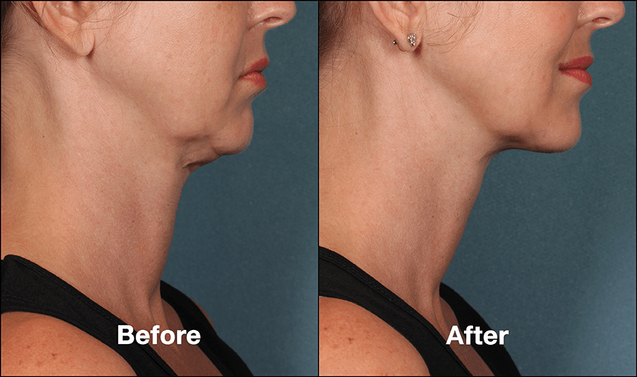 KYBELLA Injectable Double Chin Reduction Before After Photos | Atlanta ...