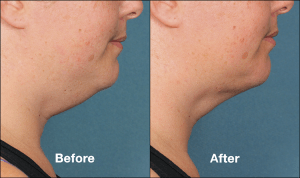 KYBELLA Injectable Double Chin Reduction Before And After Photos