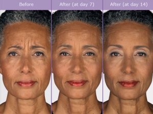 Botox Injections For Wrinkle Reduction