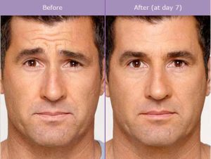 Botox Cosmetic Before And After Photos