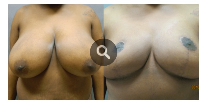 Breast Reduction Surgery Before And After Photos