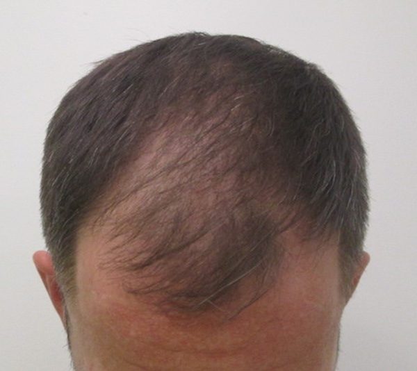Hair Restoration Procedures