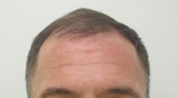 Hair Restoration Procedures